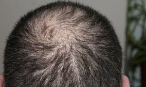 hair loss - stem cell healing institute
