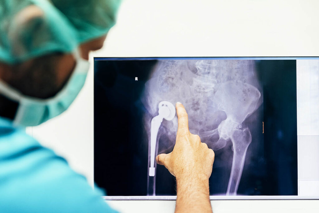 Bone Transplants